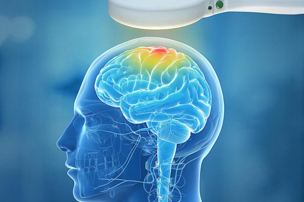 Transcranial magnetic stimulation diagram